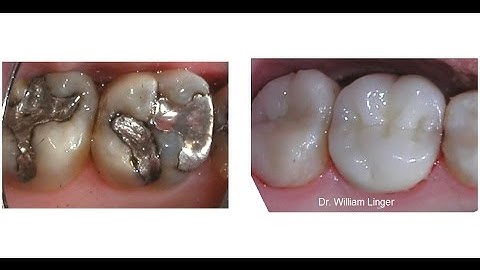 Mercury Amalgam Removal and Restoration