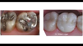 Mercury Amalgam Removal And Restoration