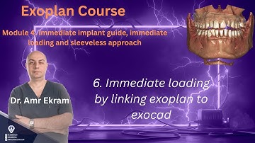 6  Immediate loading by linking exoplan to exocad