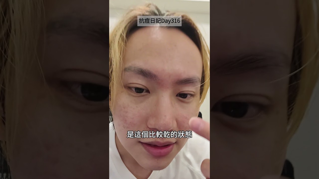 抗痘Day316!一則好消息一則壞消息🥺 上週的痘痘消了,但臉突然變好乾又泛紅!有人最近膚況也這樣嗎?急求改善泛紅的方法👇#抗痘日記 #肌膚泛紅 #換季保養 #男生保養 #抗痘戰友 縮圖
