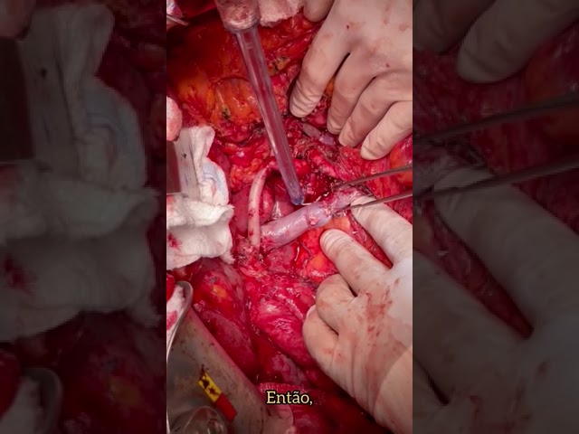 Cirurgia para ressecção de câncer de pâncreas com invasão vascular.