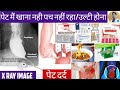           achalasia cardia treatment in hindi