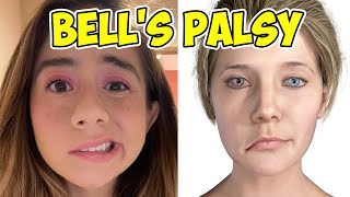 BELL'S PALSY paralyzed my wife's FACE | The Unicorn Family