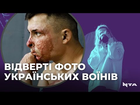 Без кінцівок і з опіками: фотограф зі Львова показує наслідки війни.