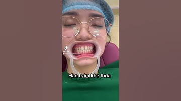 Hàn trám khe thưa răng cửa #shorts