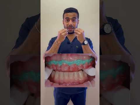 هل التبييض بيأذي الأسنان