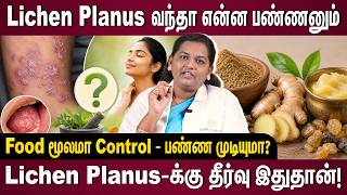 Lichen Planus வந்தா என்ன பண்ணனும்... Food மூலமா Control பண்ண முடியுமா? Dr. Revathy