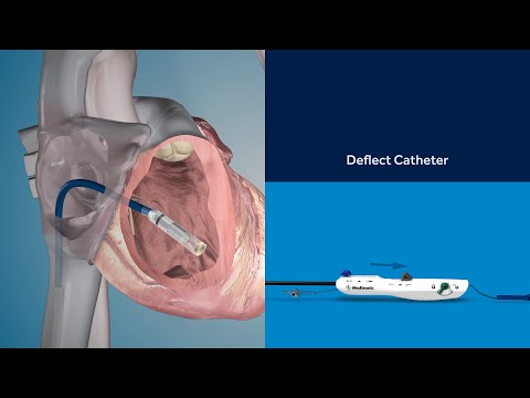 Micra TPS Implant Procedure Animation