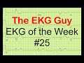 EKG/ECG of the Week #25 | The EKG Guy - www.ekg.md