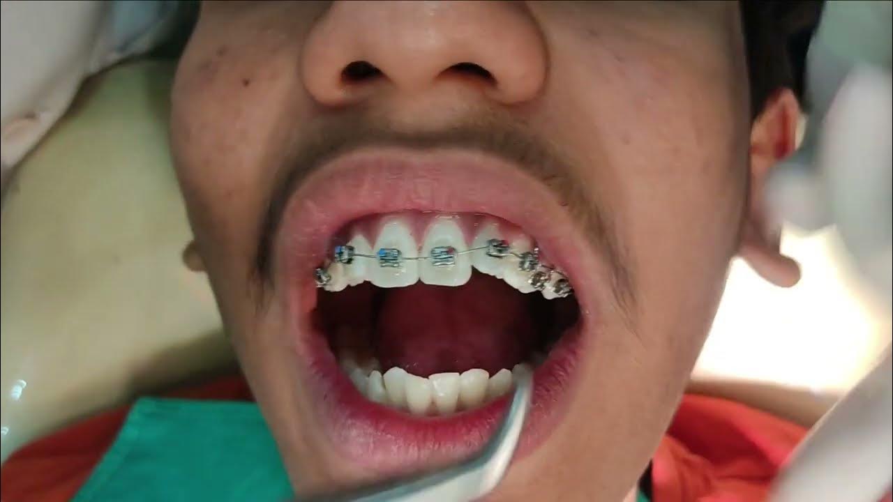 Braces bonding YouTube
