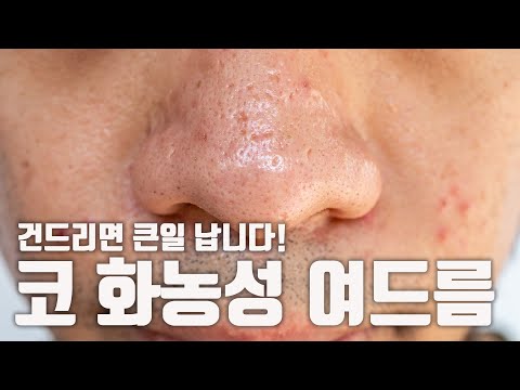 코에 난 화농성 <strong>여드름</strong> <strong>없애는</strong> <strong>방법</strong>