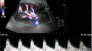 Full Convex probe, triplex mode. Blood flow in interlobar arteries. Guide