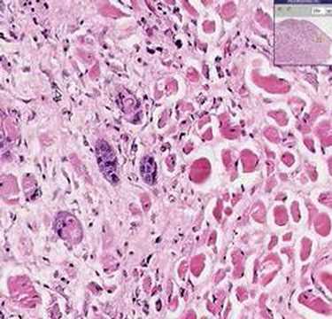 Histopathology Tongue--Squamous cell carcinoma