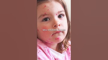 How the Measles Vaccine Inspired Cancer Treatment