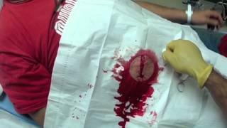 Clinical Procedure: Abdominal Laceration