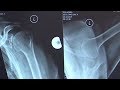 Orthopédie & physiothérapie: comment traiter avec succès une blessure à l’épaule