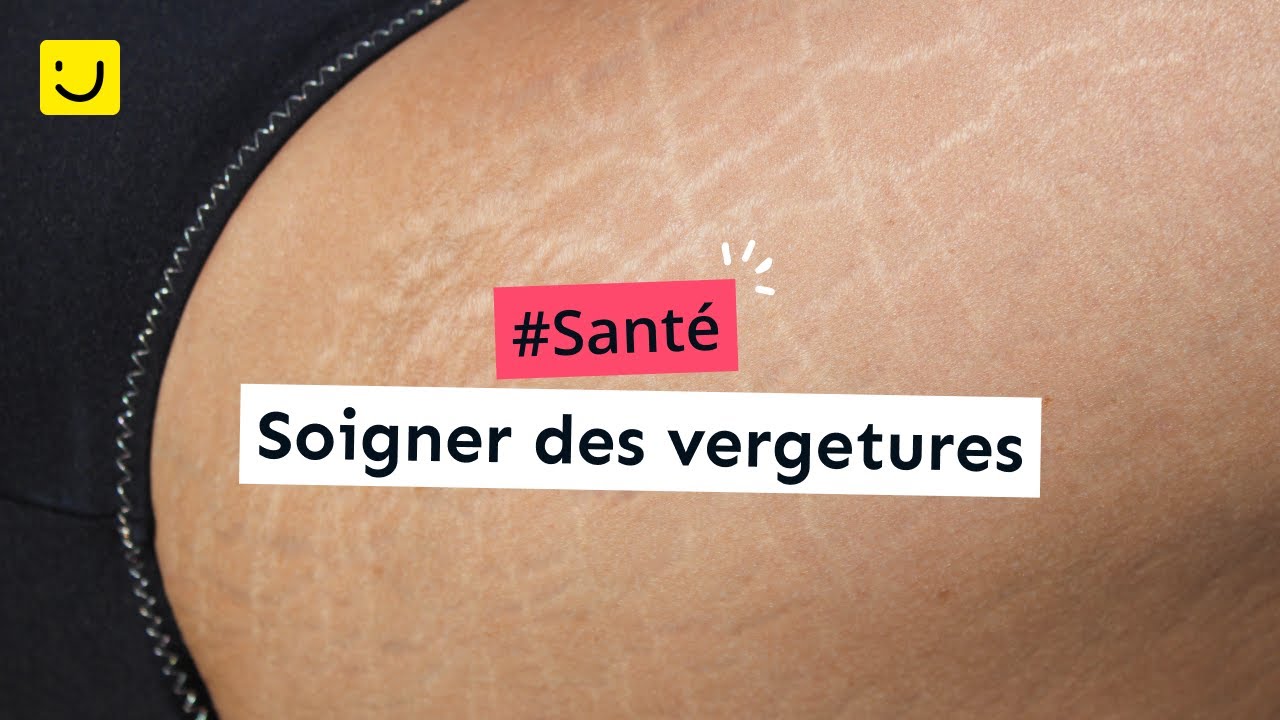 Soigner des vergetures YouTube