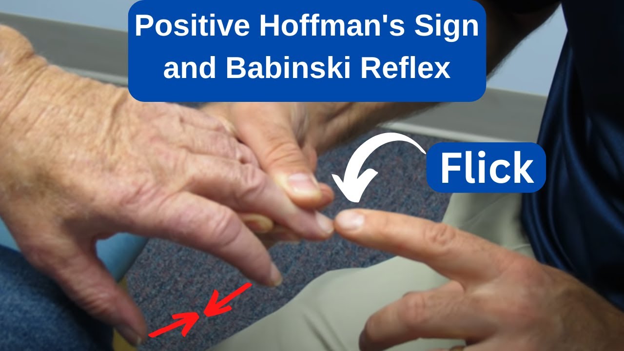 Positive Hoffmans Sign And Babinski Reflex In An Ms Patient Youtube
