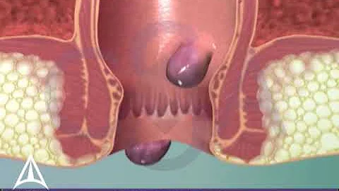 Learn about hemorrhoids with #3d #animation - DayDayNews