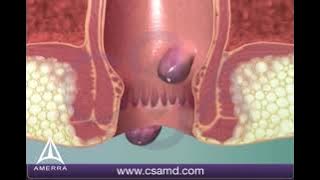 Learn about hemorrhoids with #3d #animation