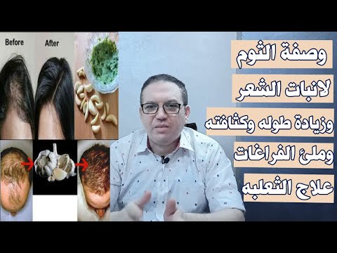 عصير الثوم لانبات الشعر وزيادة طوله وكثافته وملئ الفراغات علاج الثعلبه والصلع طريقة تحضير عصير الثوم