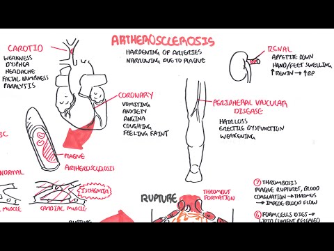 Video: Atherosclerose - Vormen, Symptomen, Klinisch Beeld