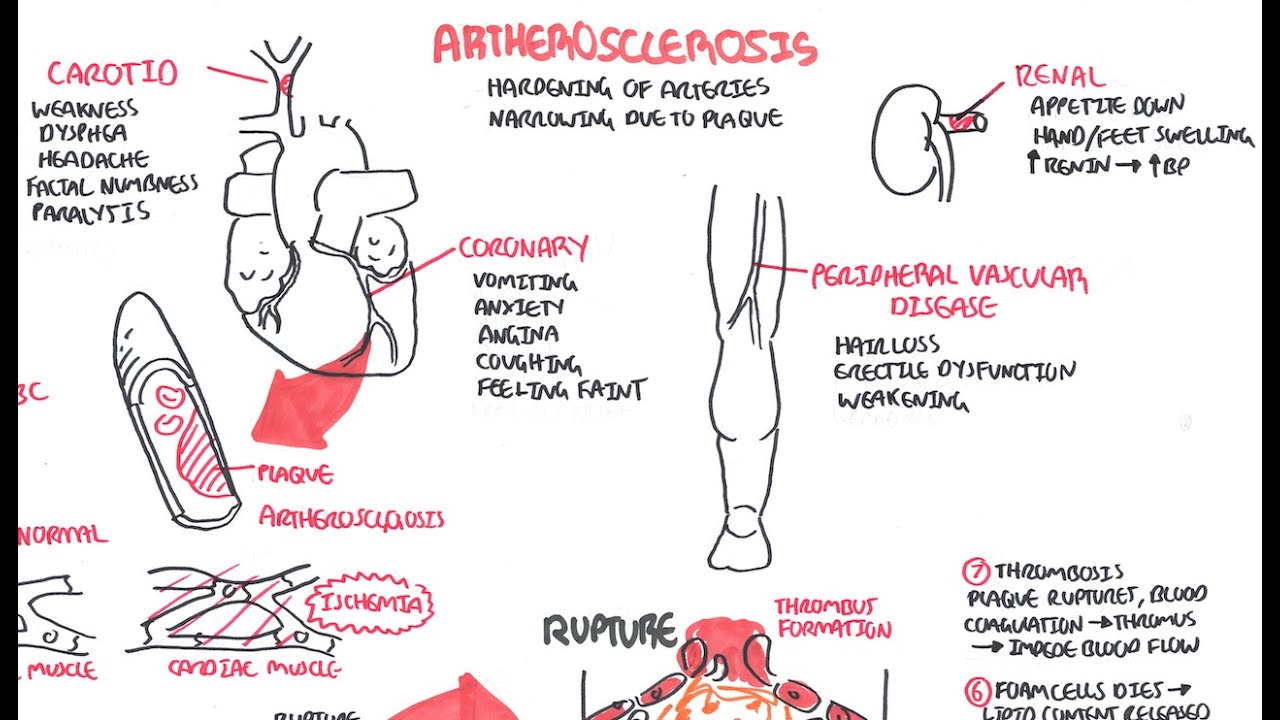 Pathophysiology Of Coronary Heart Disease In Flow Chart