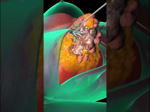 Mastectomy Breast Surgery (3D Animation)