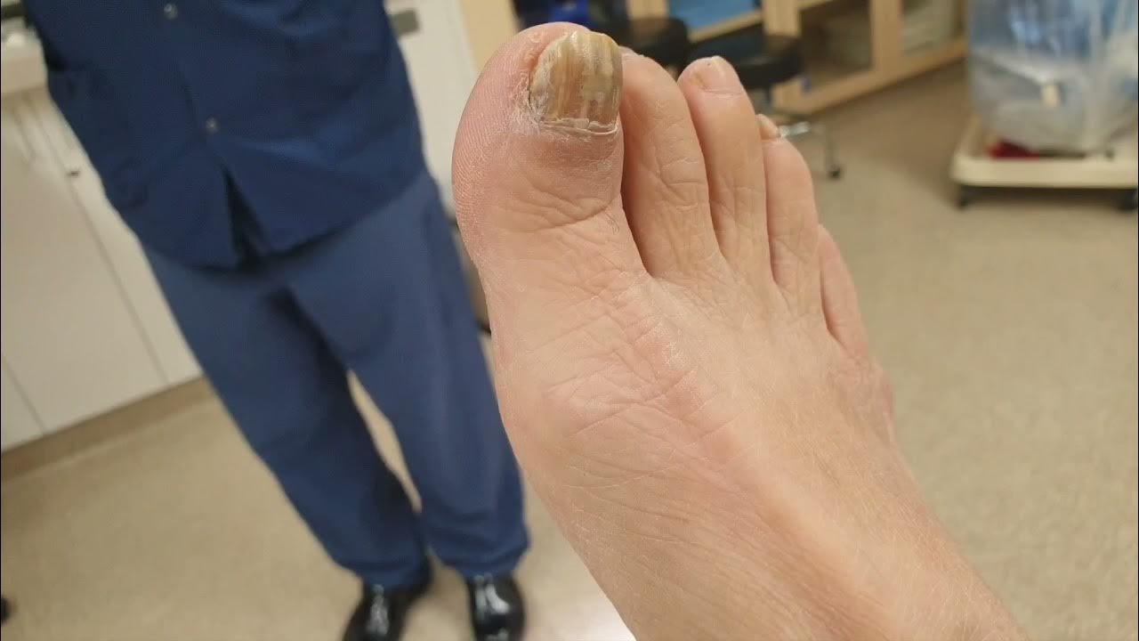 toenail spur under the nail plate YouTube