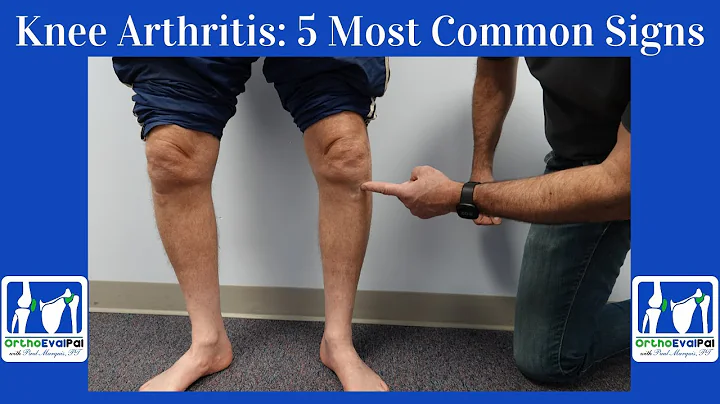 Knee Arthritis- 5 Most Common Signs You Have It! - DayDayNews