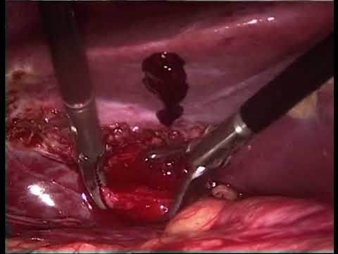 15062015 Laparoscopic cholecystectomy with intraoperative cholangiogram (LC + IOC) part 2