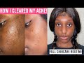 CLEARED MY ACNE WITH MINIMAL & AFFORDABLE SKINCARE PRODUCTS!! Full routine for acne-prone skin...