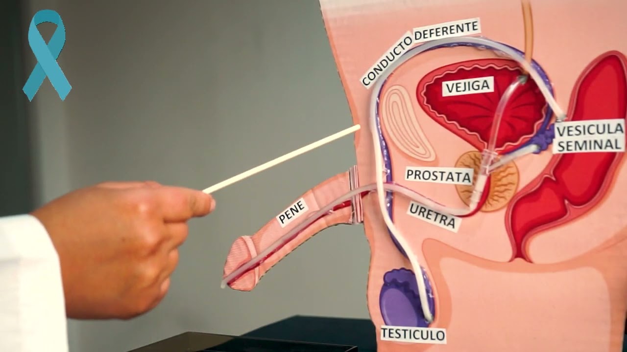 Video Cancer de Prostata