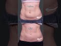 POV: summer is coming and you said “I’ll just diet” but your stubborn fat said no ❤️
