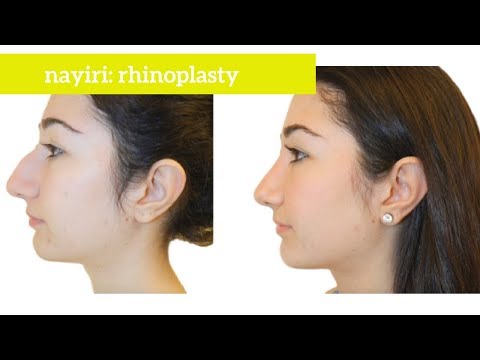 How can rhinoplasty reduce a bump on the bridge of the nose while improving nasal breathing?