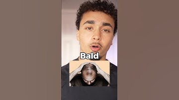 3 Signs You’re Gonna Go Bald When You’re Older