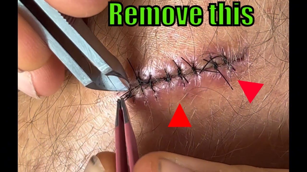 How to Remove Stitches at Home (DIY) YouTube