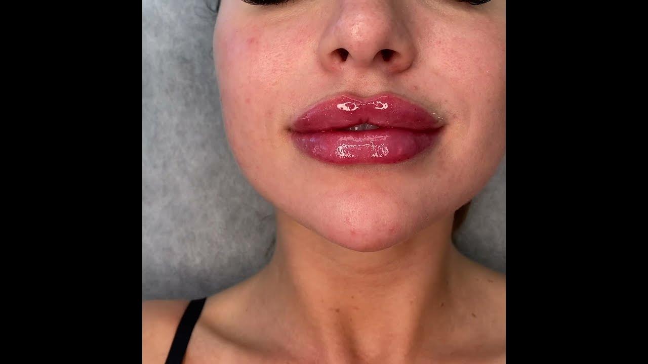 The Ultimate Guide To Skin Tightening, Botox And Lip Fillers By Skinsation La thumbnail