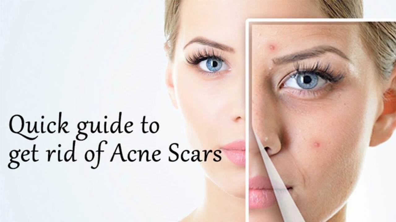 how to get rid of acne scars fast, how to get rid of acne...