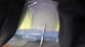 Flowable Injection Technique