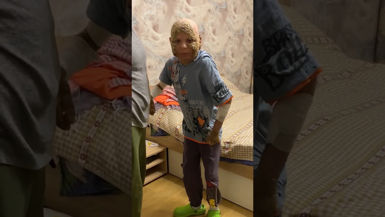 Ихтиоз