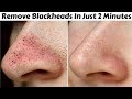 Remove Blackheads & Whiteheads in Just 2 Minutes | Best, Easy & 100% Effective Home Remedy