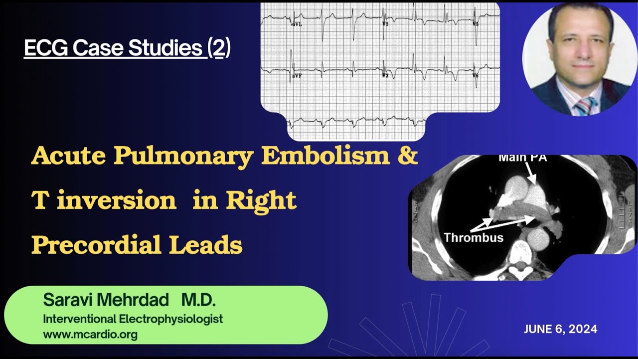 ECG Case Studies (2): Pulmonary Embolism - YouTube