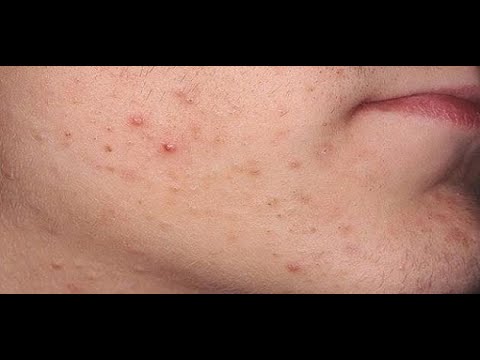 سبب ظهور الحبوب في الوجه بشكل مفاجئ