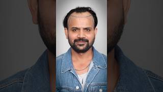 Amazing Hair Transplant Result | Latest Fue Technique #shorts #viral #hair
