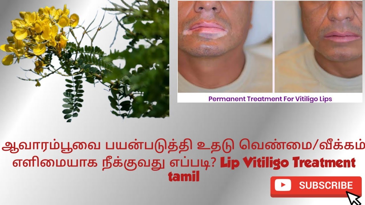 ஆவாரம்பூவை பயன்படுத்தி உதடு வெண்மை/வீக்கம் எளிமையாக நீக்குவது எப்படி