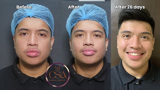 Hollywood spectra for large pores and acne marks