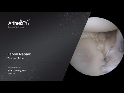Labral Repair: Tips and Tricks - YouTube