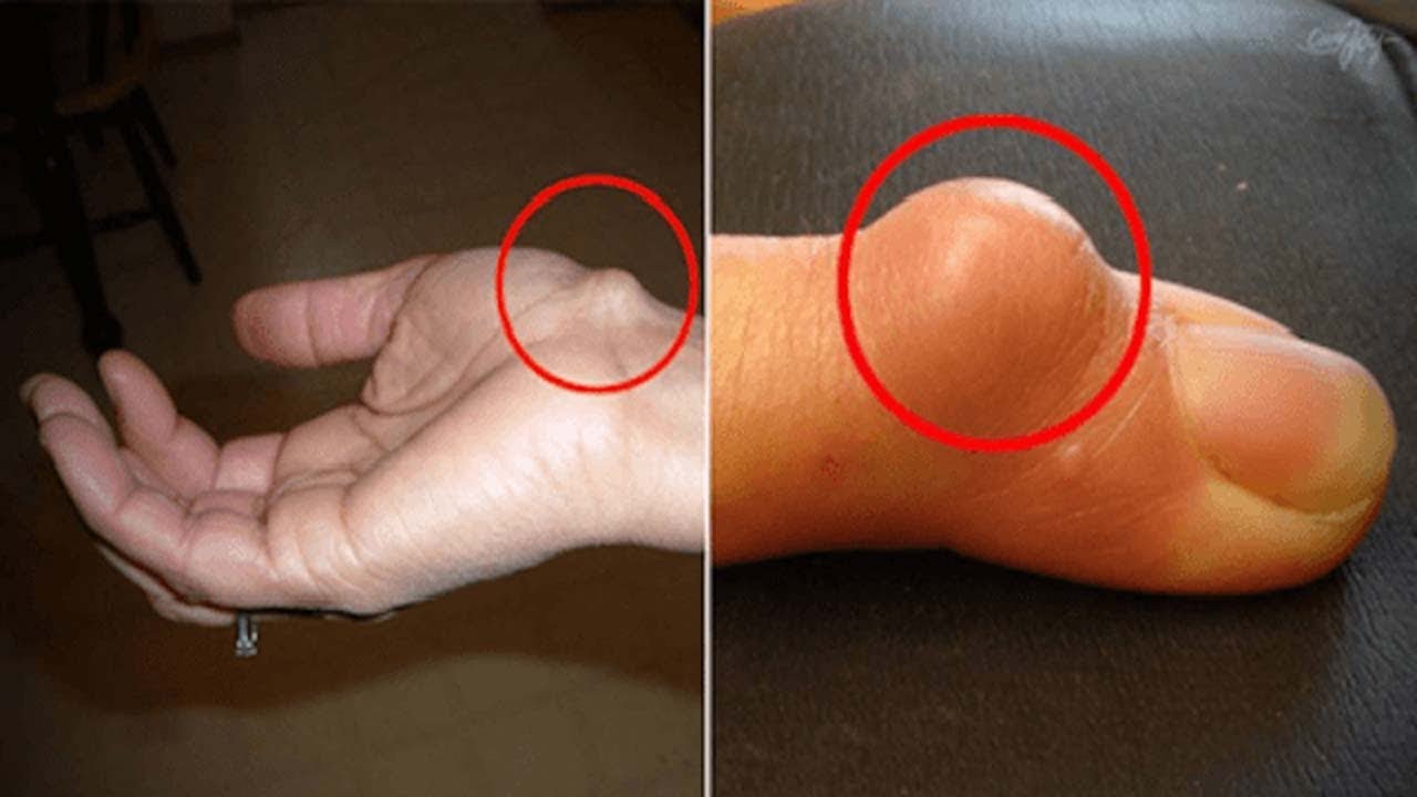 Why The Ganglion Cysts In Your Wrist Need Immediate Attention Youtube