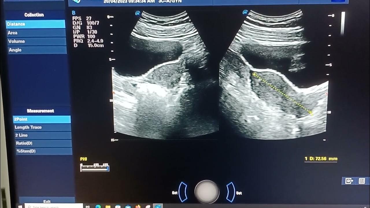how-to-measure-uterus-volume-length-ap-and-width-normal-uterus-in